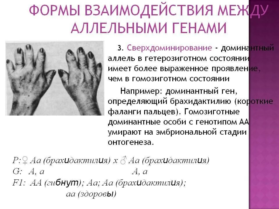 Ген в гетерозиготной форме. Брахидактилия наследуется по типу. брахидактилия тип наследования. ген в гетерозиготном состоянии что это. брахидактилия это в генетике.