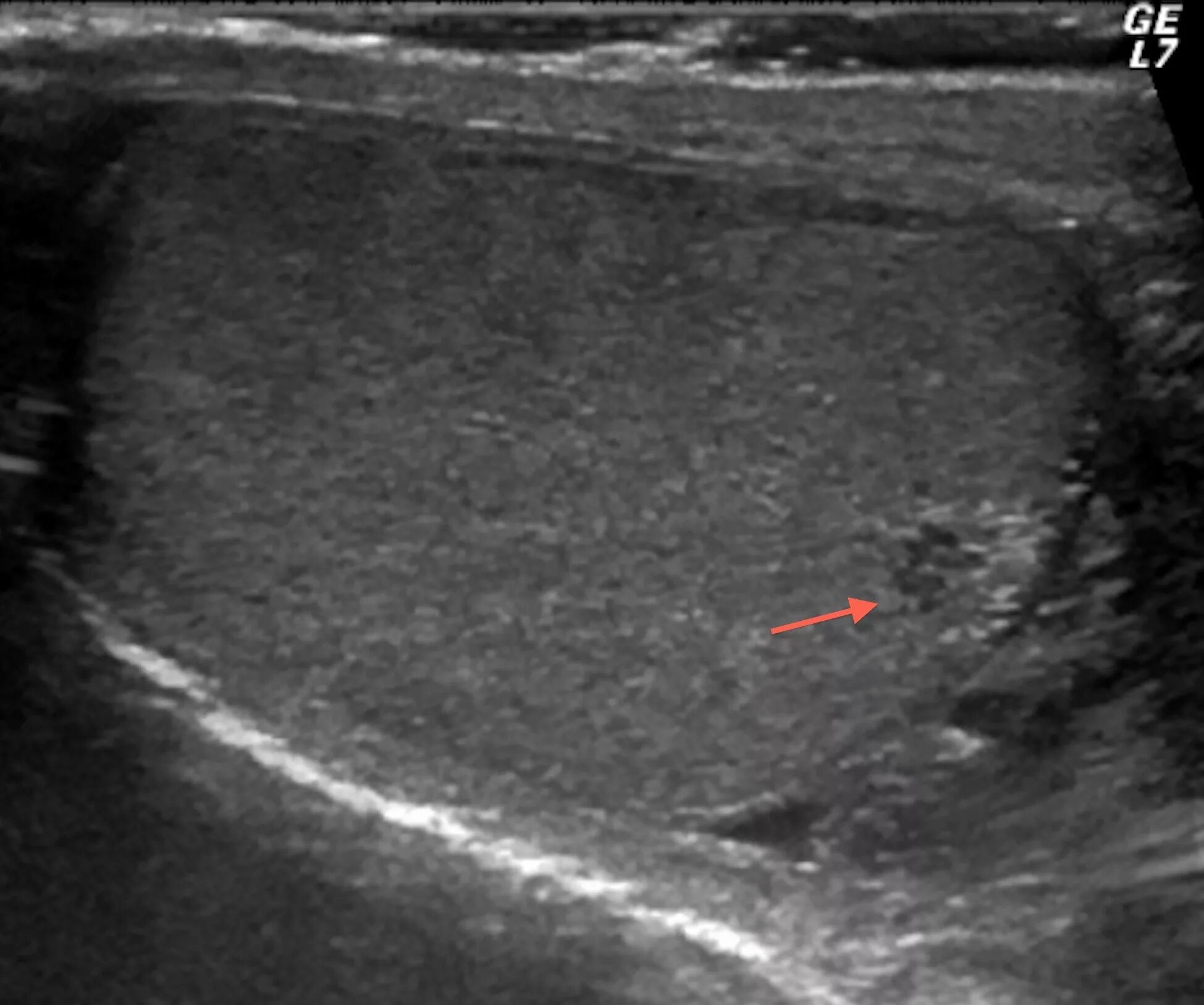 Образование придатка яичка. Образование придатка яичка УЗИ. Опухоли придатка яичка на УЗИ. Эктазия rete Testis яичка на УЗИ.