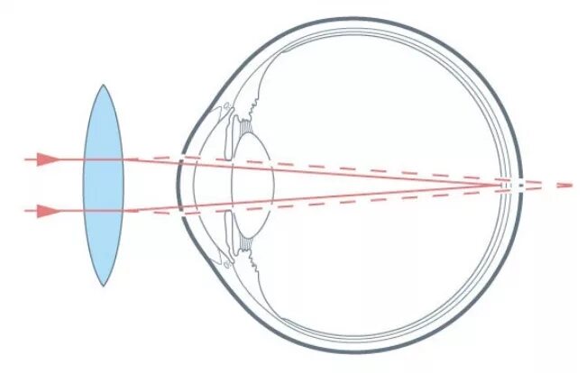 Двояковыпуклая линза при дальнозоркости. Линзы при близорукости двояковыпуклые. Пресбиопия линзы. Гиперметропия линзы. Линзы для зрения дальнозоркость