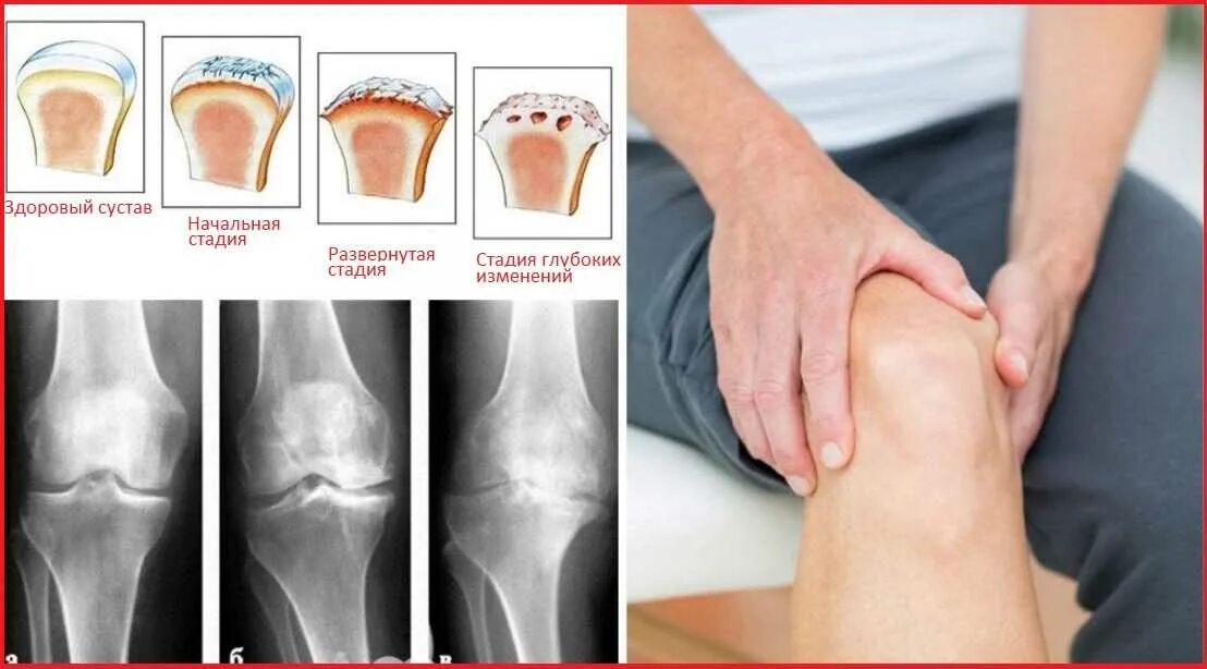 Эффективное лечение артроза сустава. Артропатия коленных суставов. Артрозо-артрит коленного.