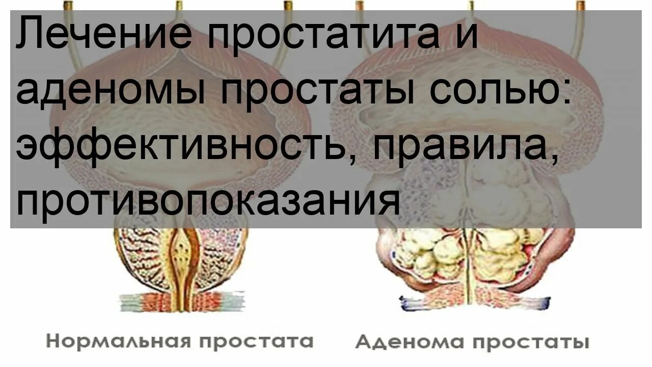 Солевые повязки от простатита. +Солевая повязка на аденому простаты. Аденома и солевые повязки. Солевые повязки при аденоме простаты. Лечение простатита отзывы мужчин