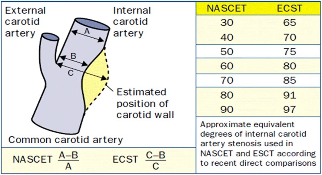 Процент стеноза сосудов. Степень стеноза по nascet. Измерение стеноза по nascet. Измерение стеноза ВСА. Степень стеноза сонных артерий по nascet.