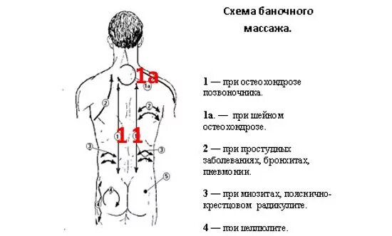 Банки при болях в спине. Вакуумный массаж спины схема. Массаж банками вакуумными для спины схема. Вакуумные банки схемы установки. Схема установки вакуумных банок.