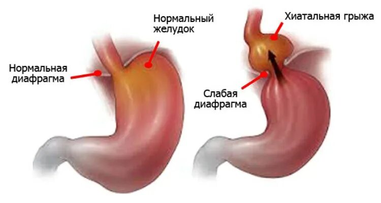 Грыжа пищевода признаки симптомы. Грыжа диафрагмы пищевода 1 степени. Аксиальная хиатальная грыжа желудка. Аксиальная хиатальная грыжа 1 степени. Аксиальная хиатальная грыжа пищеводного отверстия диафрагмы.