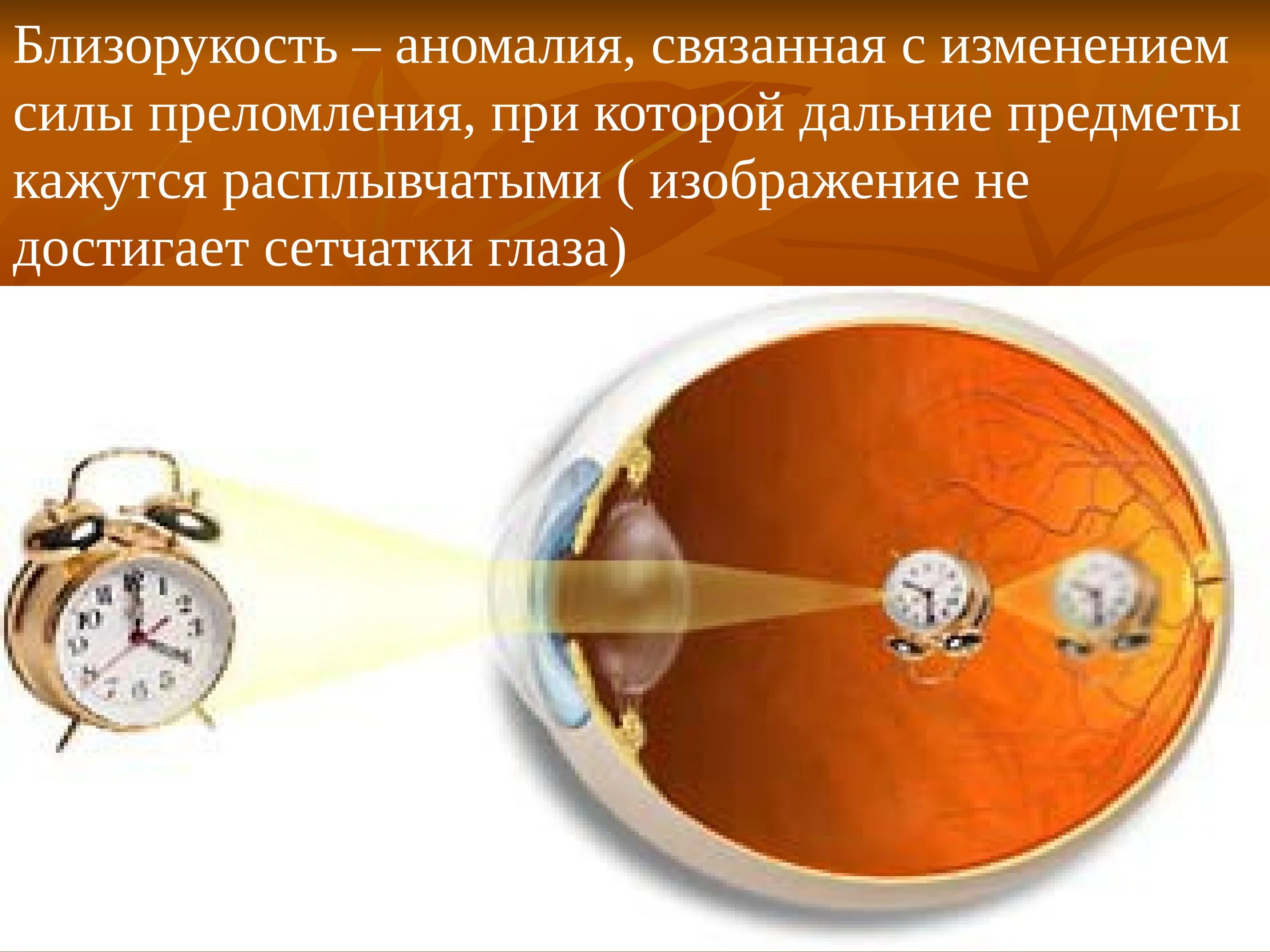 Что видит какой то предмет. Дальнозоркость. Дальнозоркость (гиперметропия). Дальнозоркость близкие предметы. Дальнозоркий глаз.