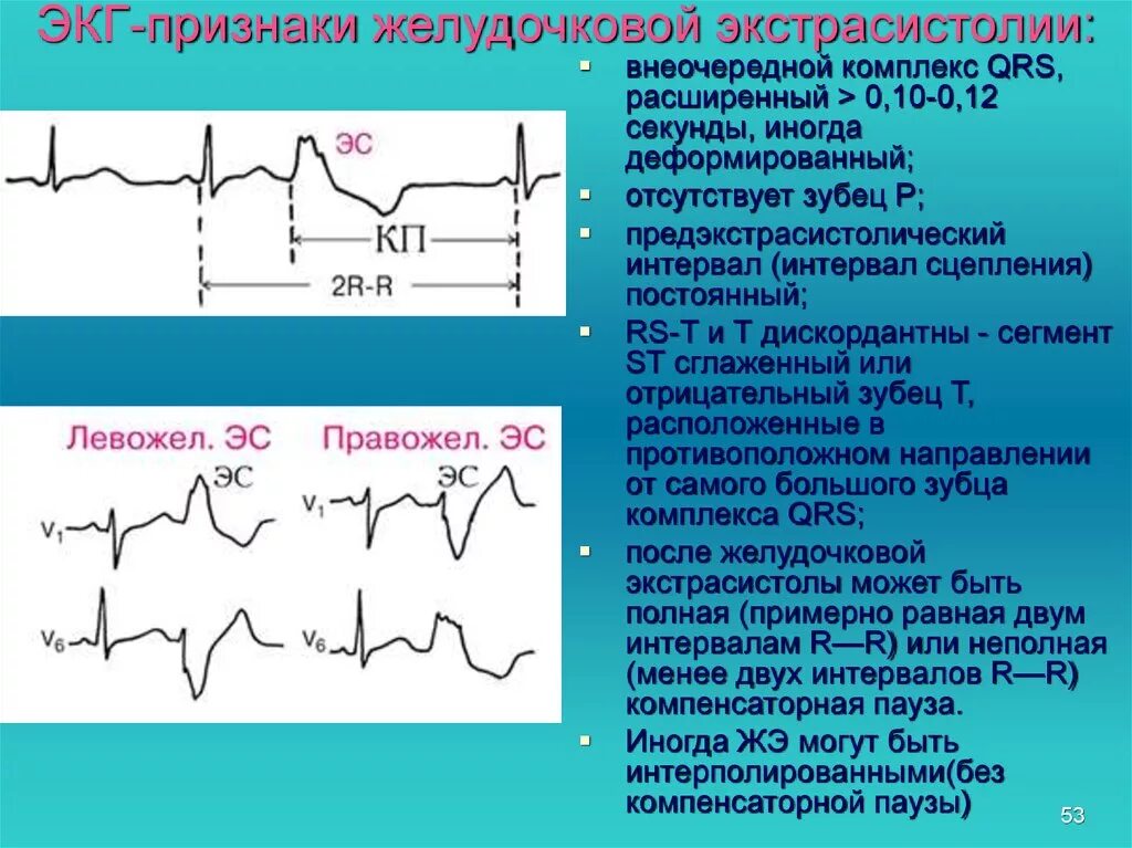 Признаки эс. ЭКГ монотопные желудочковые экстрасистолы. Желудочковая экстрасистолия на ЭКГ. Желудочкова яаритмия ЭУГ. ЭКГ-критерий желудочковой экстрасистолии.