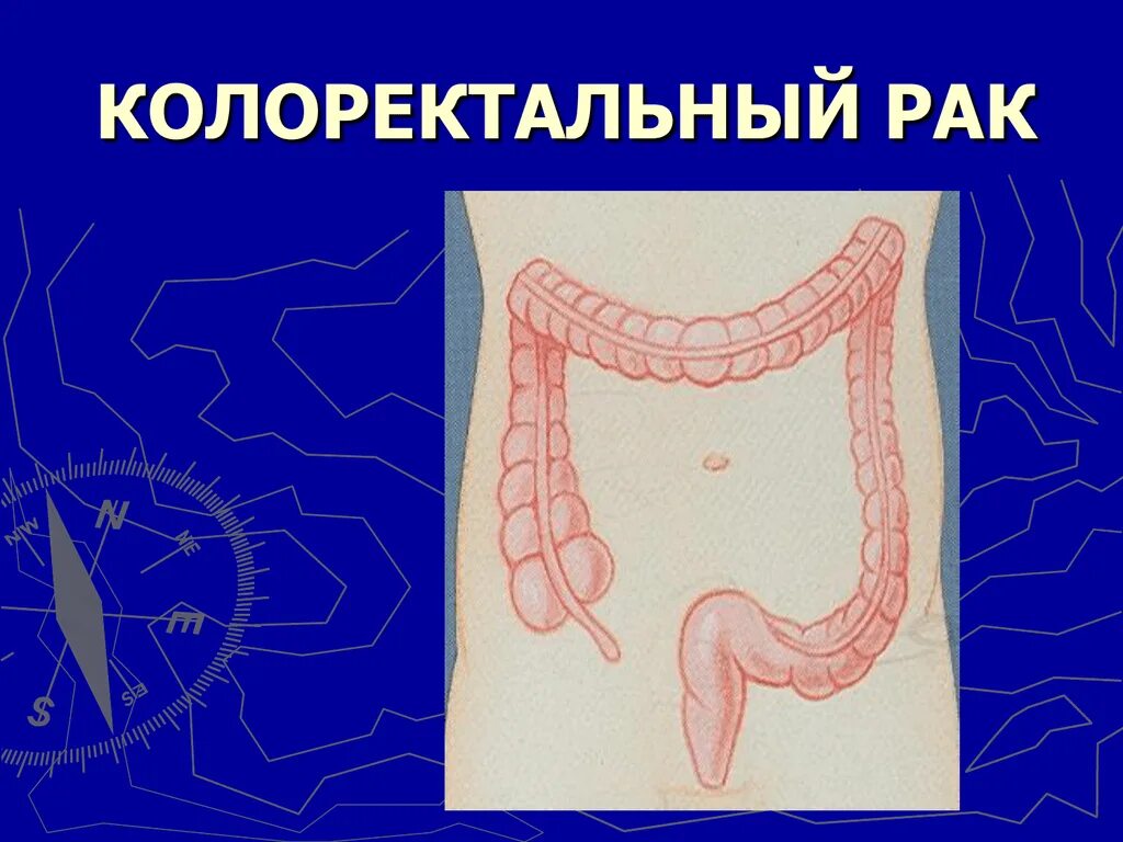 Колоректальный рак. Колоректальных карцином.. у кого колоректальный рак?. околоректальная область.