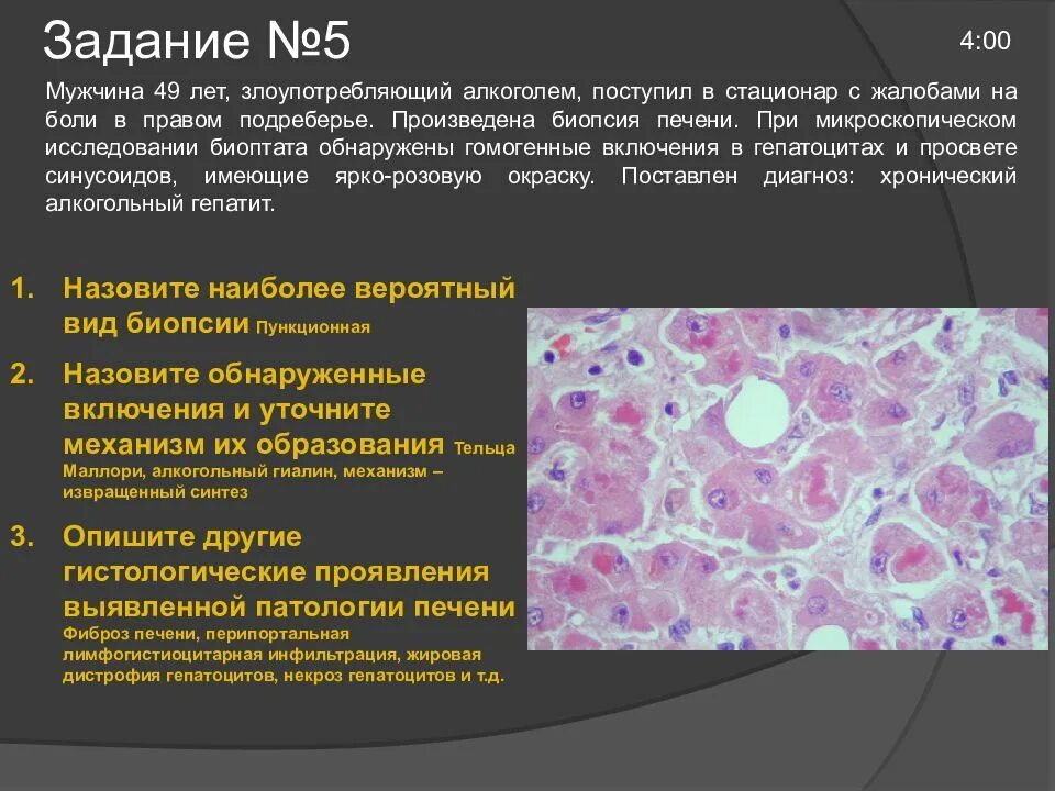 Плотный наблюдаться. Инфильтрация патанатомия. Патологическая анатомия микроскопическое исследование. Биопсия клиническая патанатомия. Гистологические исследование биоптата печени.