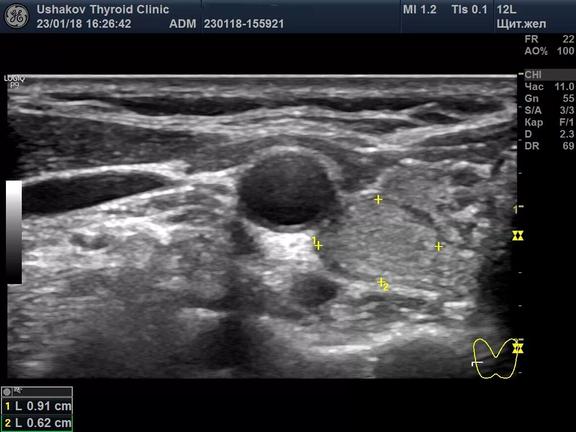 Узловые образования обеих долей щитовидной железы. Анэхогенный узел щитовидной железы. Щитовидная железа узелок на УЗИ. Измерение узлов щитовидной железы. УЗИ щитовидной железы микрокальцинаты.