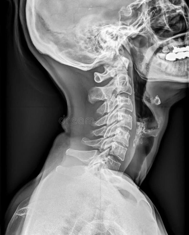 Рентген черепа и позвоночника. Рентгеновский снимок шеи. Рентген шеи и поясницы. Между черепом и позвоночником