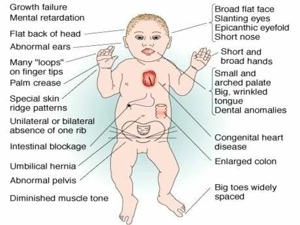 Синдром Дауна. Синдром Дауна клиническая картина. Черты синдрома Дауна у новорожденных. Лишняя 21 хромосома