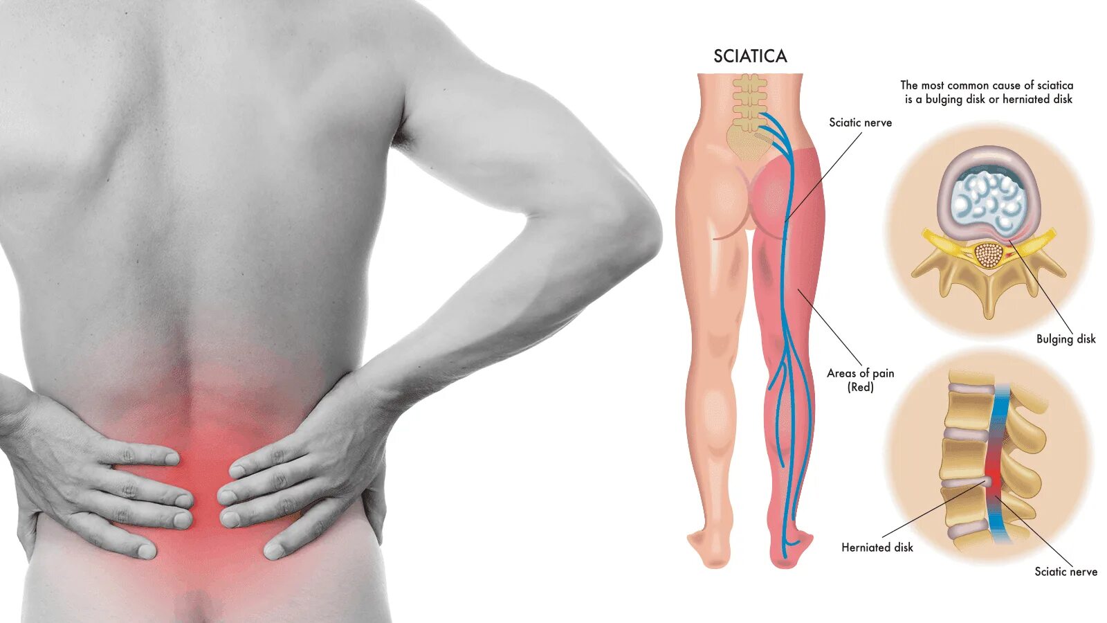 Боль в пояснице отдает в правую сторону. Седалищный нерв (sciatic nerve)? 011. Боль в пояснице. Болит поясница.