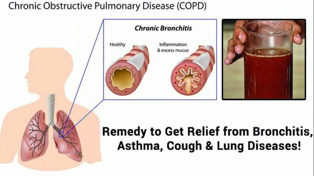 “Asthma bronchial….” (Бронхиальная астма):.