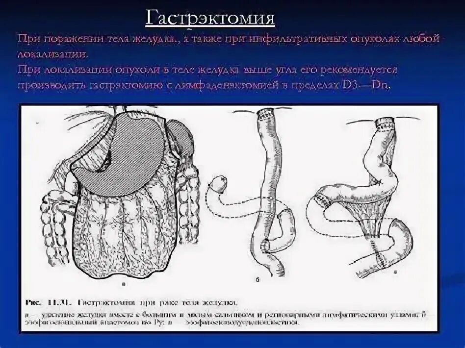 Классификация желудка. Классификация желудка. Злокачественная опухоль желудка. Злокачественная опухоль желудка. Причины онкологии желудка.