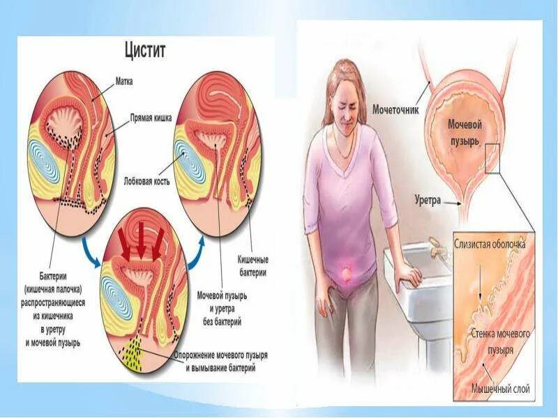 При цистите есть выделения