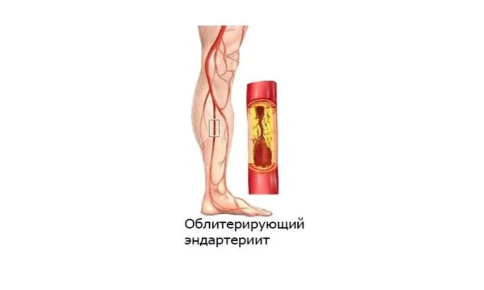 Облитерирующий атеросклероз код. Облитерирующий эндартериит и тромбангиит. эндартериит и атеросклероз. облитерирующий атеросклероз артерий симптомы. облитерирующий атеросклероз и эндартериит.