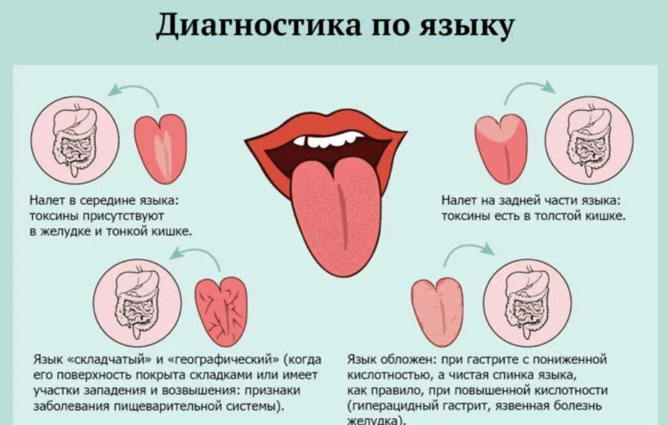 Симптомы по цвету языка. Болезни по языку определить. Язык при аппендиците