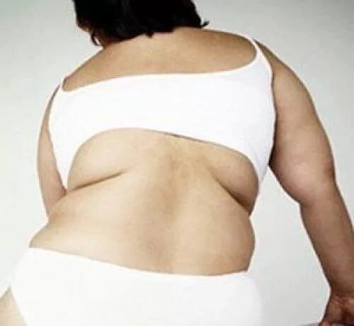 Гормональное ожирение у женщин. Эндокринное ожирение у женщин. Гормональный лишний вес у женщин.