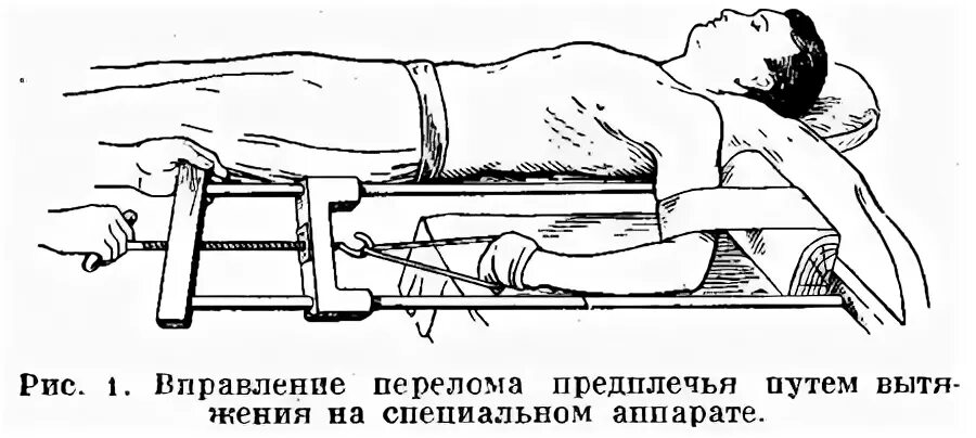 Вправление грыжи