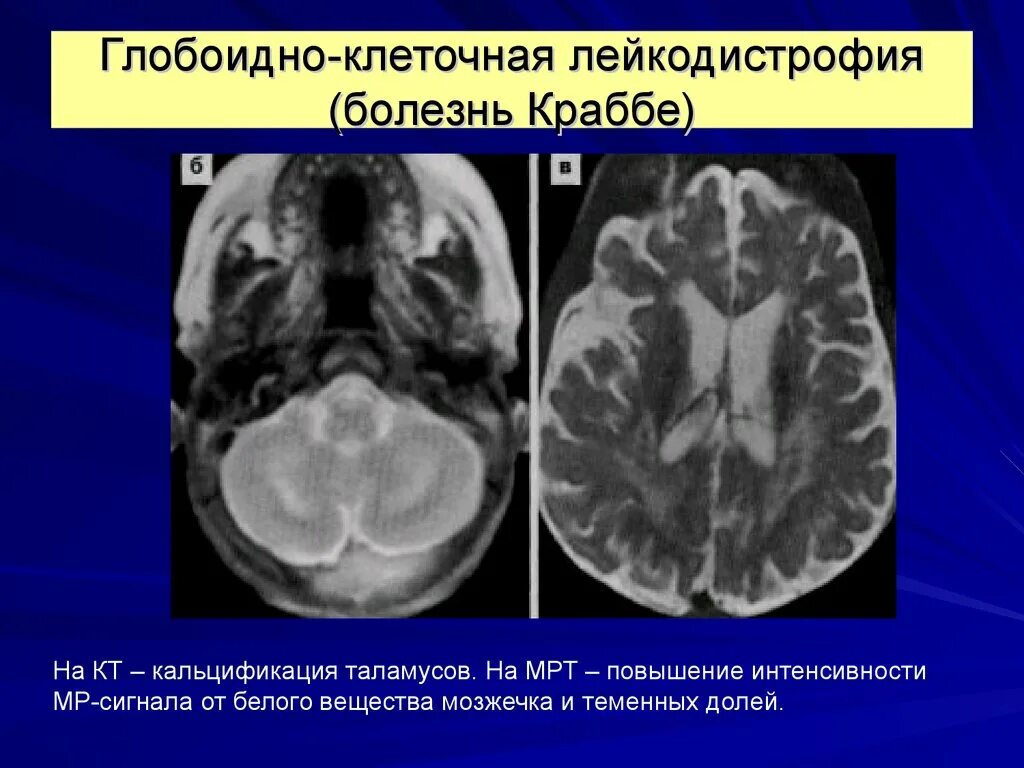 Лейкодистрофия Краббе. Глобоидно-клеточная лейкодистрофия. Болезнь краббе простыми словами