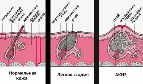 Стадии прыща