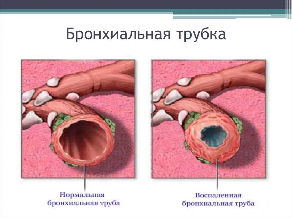 Спадение бронха