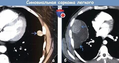 Саркома легкого