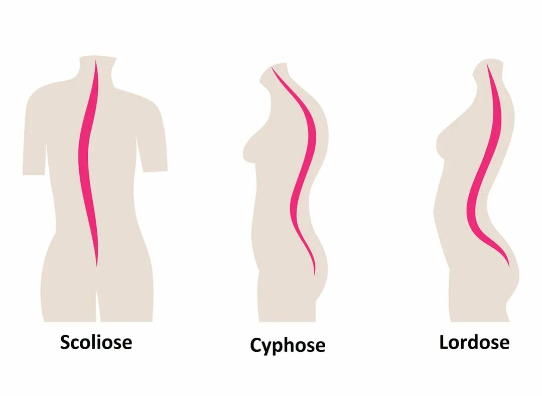 Гиперлордоз и выпирающий живот. Лордоз. Неправильный изгиб поясницы. Лордоз кифоз сколиоз.