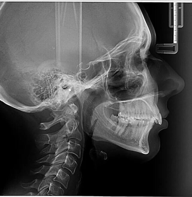 Source x rays