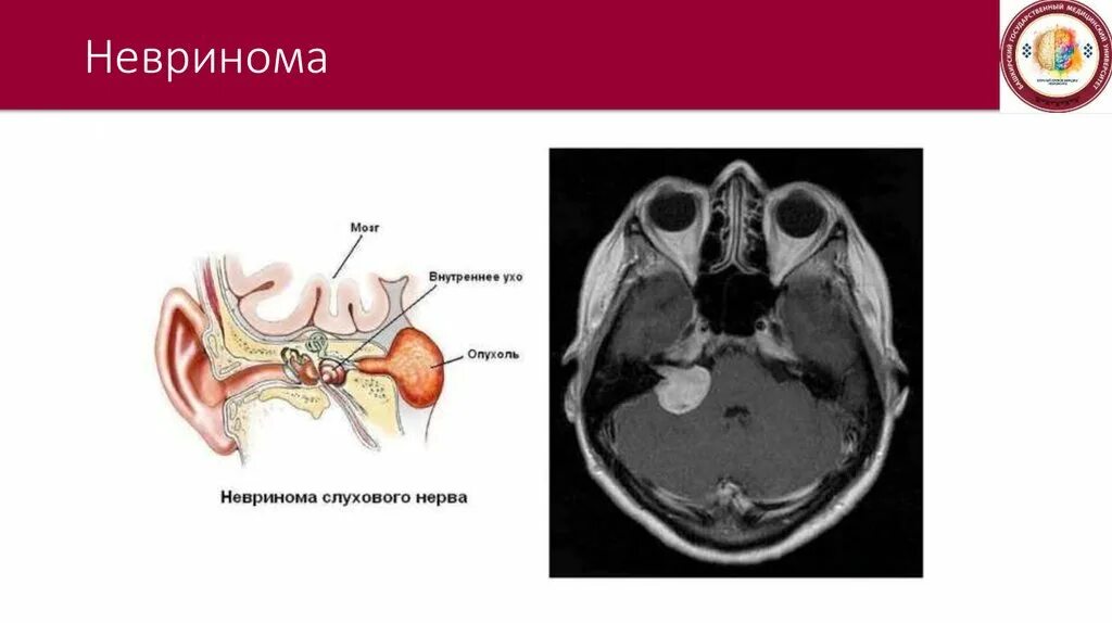 Поражение слухового нерва. Невринома слухового нерва клиника. Невринома слухового нерва на кт. Невринома преддверно-улиткового нерва мрт. Невринома слухового нерва (акустическая шваннома).
