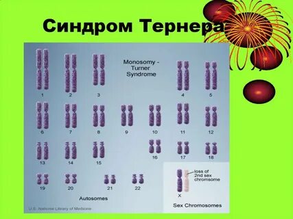 Кариотип шерешевского тернера