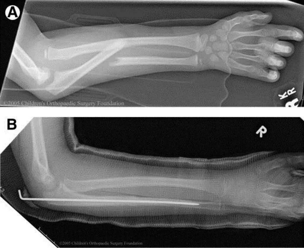 Лучевая трещина. Перелом Монтеджи рентген. Рентген перелома кости предплечья. Перелом диафиза лучевой кости гипс. Перелом диафизов локтевой и лучевой костей.