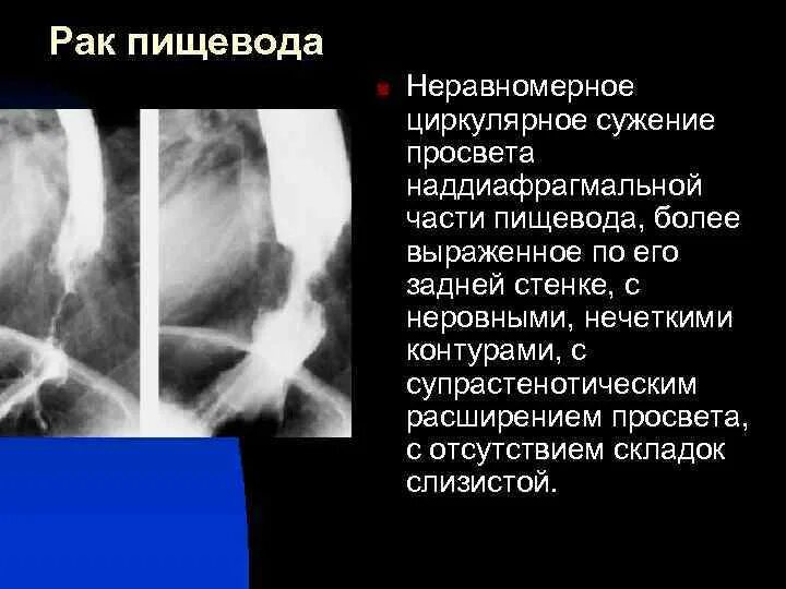 Просвет пищевода. Циркулярное сужение пищевода. Циркулярный стеноз пищевода. Расширение просвета пищевода. Лучевая диагностика заболеваний пищевода.