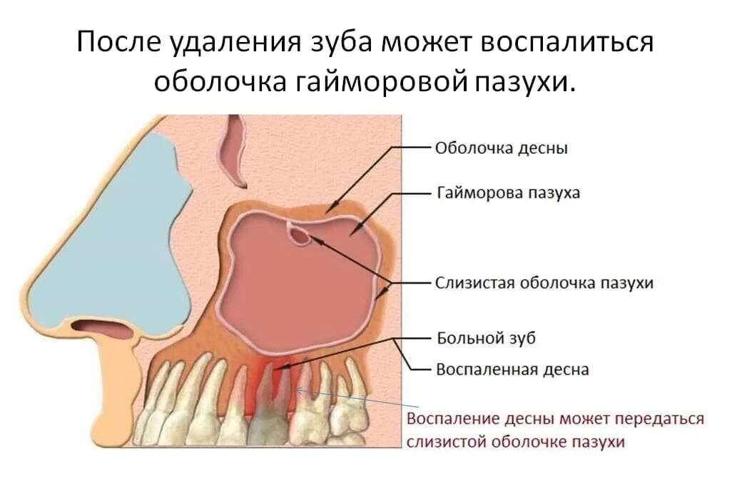 Полость страдать. Одонтогенное воспаление верхнечелюстной пазухи гайморит. Острое воспаление гайморовых пазух. Катаральный одонтогенный гайморит. Острый одонтогенный верхнечелюстной синусит симптомы.