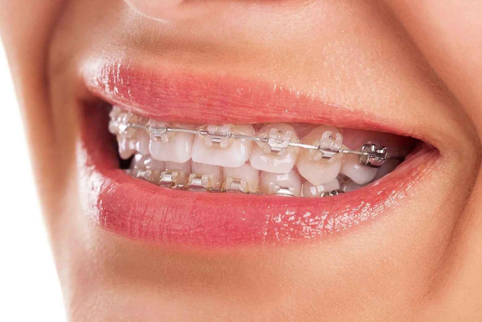 Brackets photo