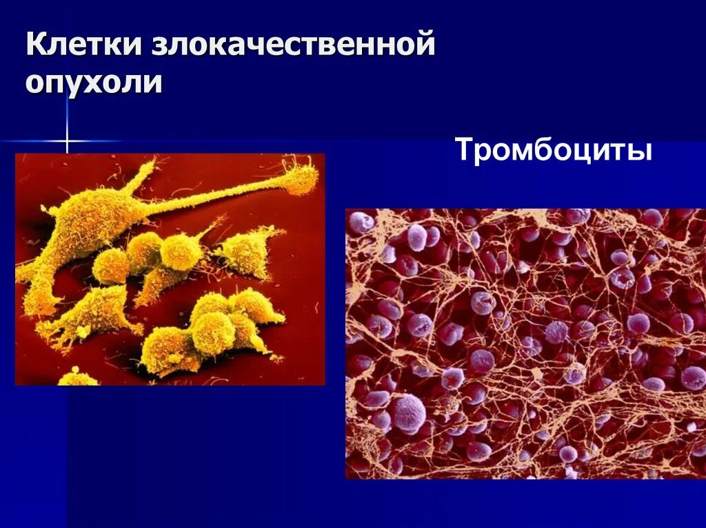 Злокачественная опухоль. Клетки доброкачественных опухолей. Клетки злокачественной опухоли. Клетка злокачественного новообразования. Опухоли и др