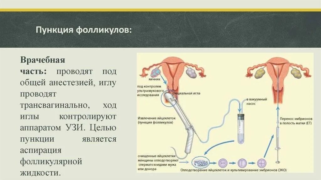 Пункция забора яйцеклетки. Пункция яичников ооцитов. Эко пункция яйцеклеток. Боли после пункции фолликулов