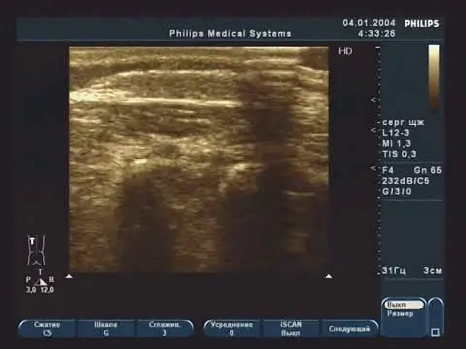 Узи мягких тканей плеча заключение. Узи мягких тканей (1 анатомическая зона). Метастазы в мягких тканях. Ультразвуковое исследование позвоночника. Узи картина липомы мягких тканей.