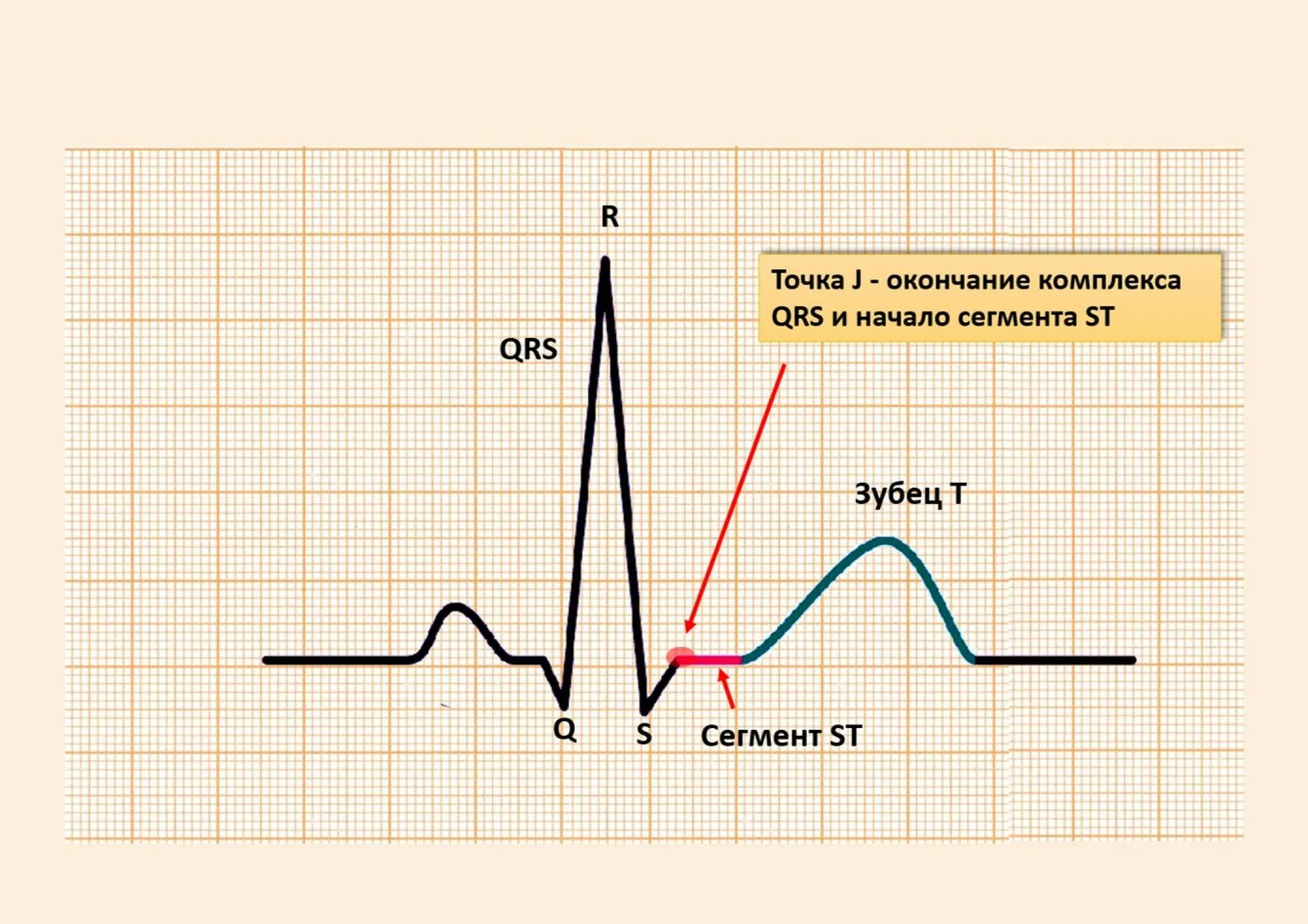 Найти точку дж. Элевации сегмента St на ЭКГ. Элевация сегмента ст на ЭКГ. Сегмент St на ЭКГ. Элевация точки j на ЭКГ.