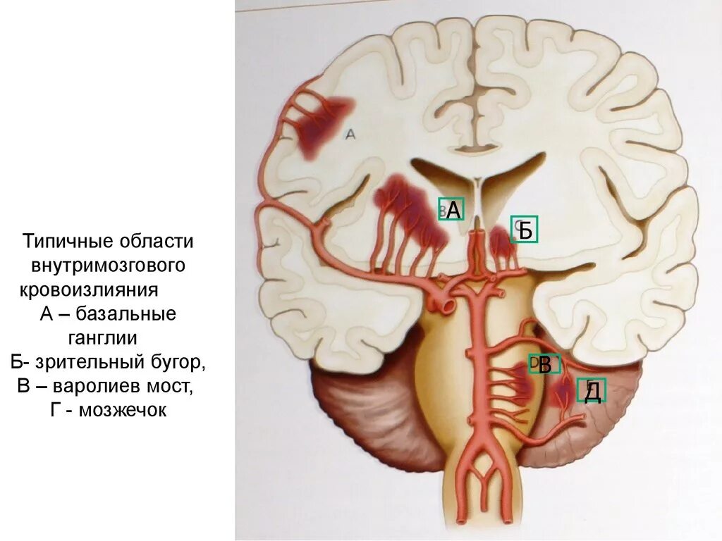 Кровоизлияние ствола мозга. Субарахноидальный инсульт кт. Субарахноидальное кровоизлияние патанатомия. Геморрагический инсульт в базальных ядрах. Внутримозговое кровоизлияние левого таламуса.