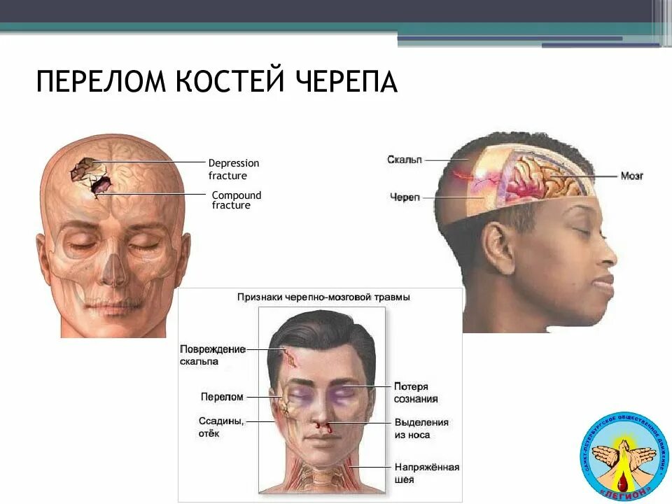 Перелом костей свода основания черепа симптомы. Симптомы повреждения костей черепа. Черепно мозговая травма с переломом костей черепа. Симптомы перелома костей основания черепа.