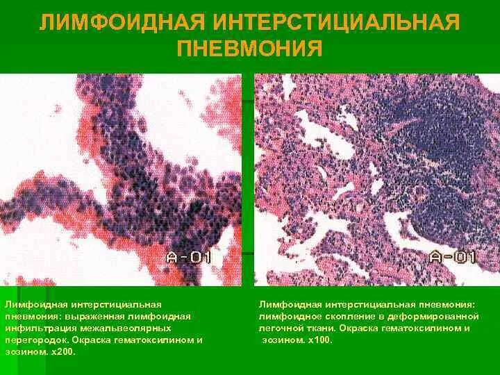 Лимфоидная инфильтрация что это. Лимфоцитарная интерстициальная пневмония. Лимфоидная интерстициальная пневмония. Неспецифическая интерстициальная пневмония. Лимфоидноклеточная инфильтрация.