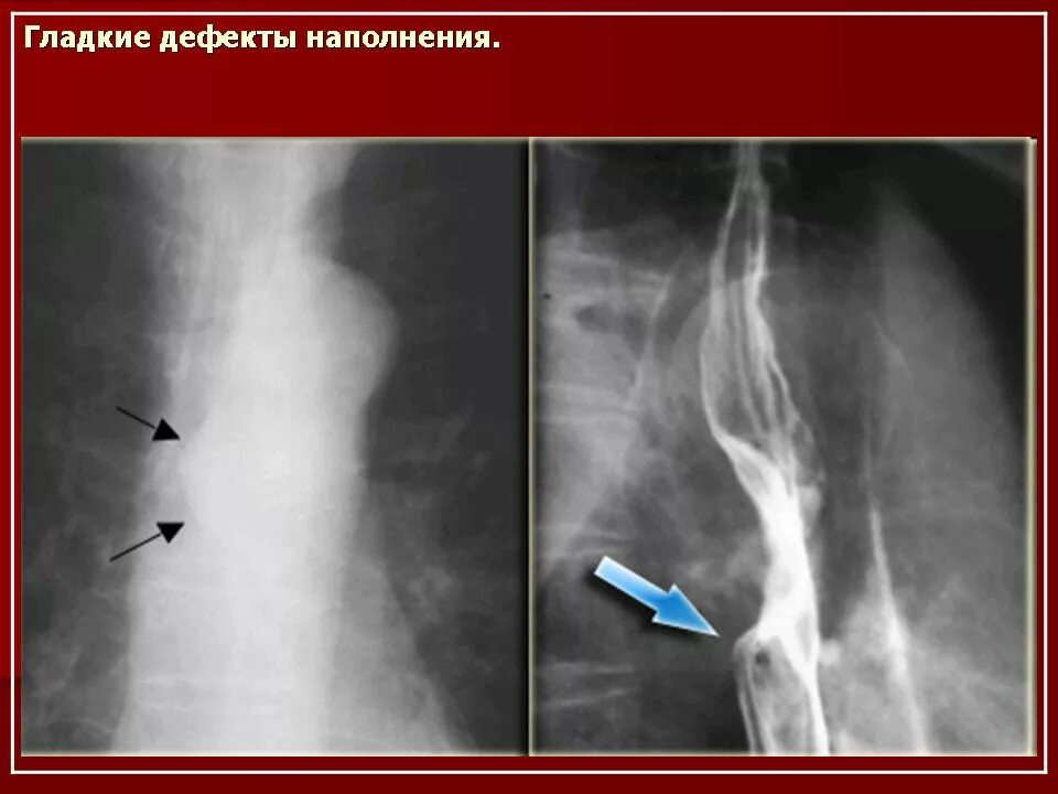 Степени расширения пищевода. Лейомиома пищевода рентген. Варикозное расширение вен пищевода ФГДС. Варикозное расширение вен пищевода рентгенограмма. Варикоз вен пищевода рентген.