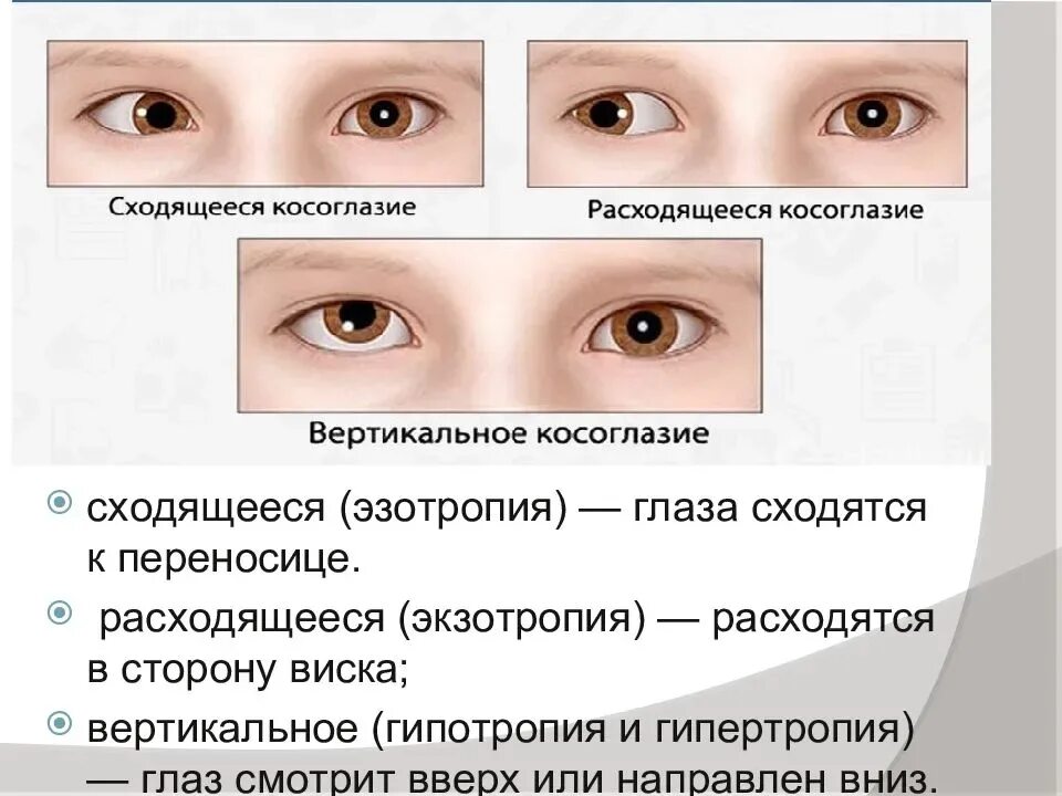 Координация движения глаз. Расходяшие косрюоглазия. Сходящееся косоглазие. Эзотропия сходящееся косоглазие. Расходящееся косоглазие причины.