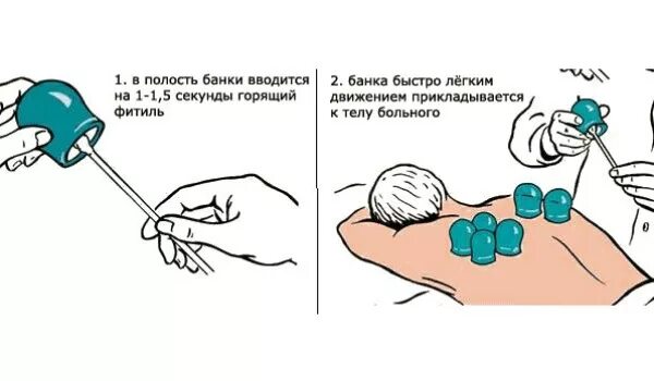 Банки при болях в спине. Схема постановки банок при бронхите. Как правильно ставить банки на спину при кашле. Как правильно поставить медицинские банки при кашле. Как правильно ставить банки при кашле взрослому схема.