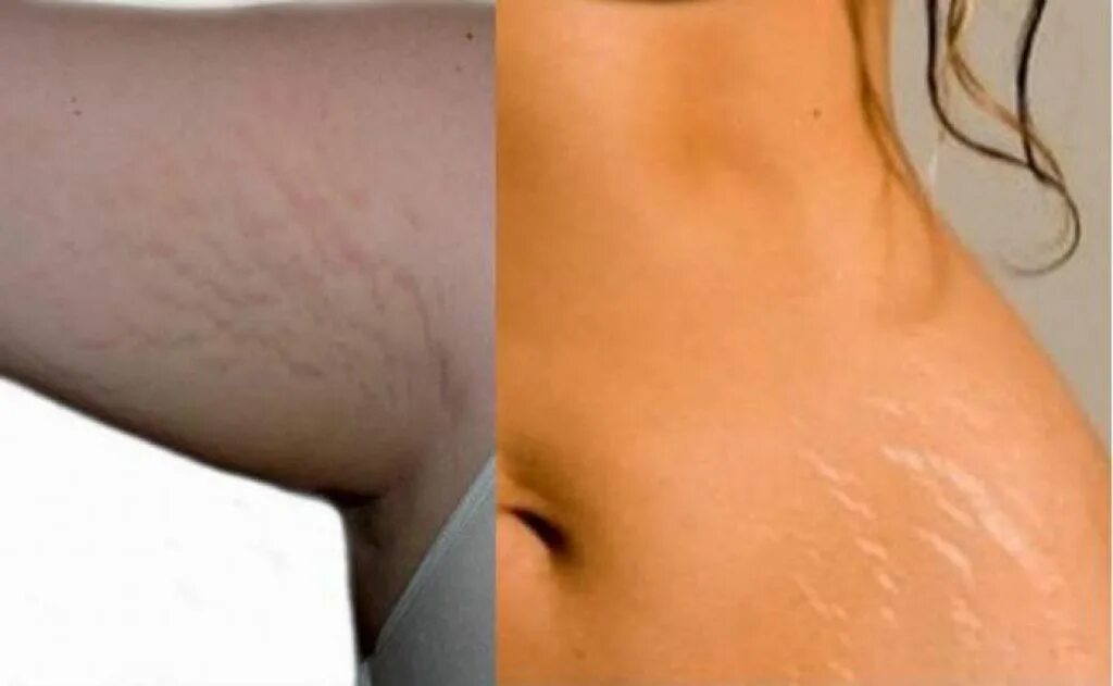 Растяжки на руках у мужчин. Спор мужчин из фильма руки на бедрах. Растяжки на руках у мужчин. Растяжка мужчины плечи. Отрыв сухожилия двуглавой мышцы.