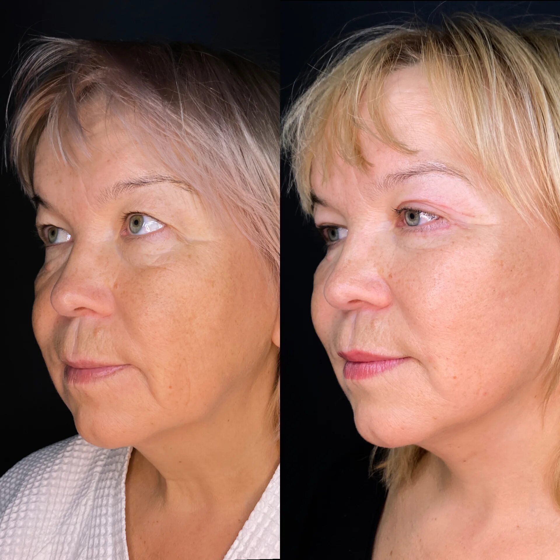 Facelifting отзывы