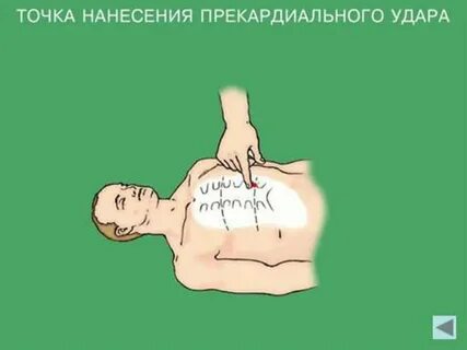 Нанесение прекардиального удара в область грудины