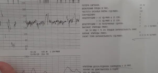 Тонус матки 36 недель беременности. Ктг при родовой деятельности. Гипертонус матки при беременности 2 триместр узи. Ундулирующий ритм на ктг. Тонус матки при беременности 2 триместр узи.