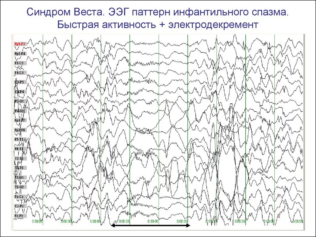 Эпи ээг. Эпилептические паттерны на ЭЭГ. Иктальный паттерн на ЭЭГ при эпилепсии. Региональная эпилептиформная активность ЭЭГ.